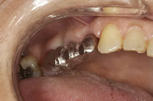 Metal framework of the final implant bridge tried in