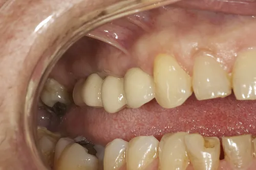 Retracted view of final implant supported bridge in situ