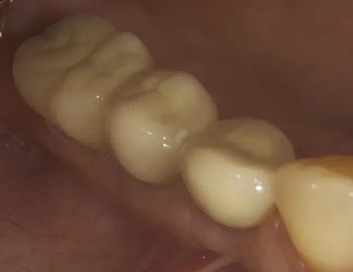 After treatment: Replacing several teeth with an implant-supported bridge