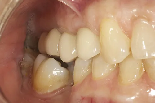 Close up of retracted post operative final bridge