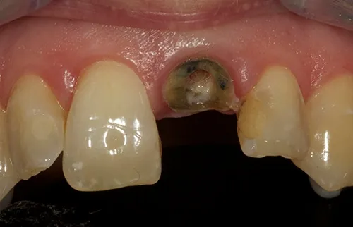 Before treatment: Replacing a single tooth with an implant crown
