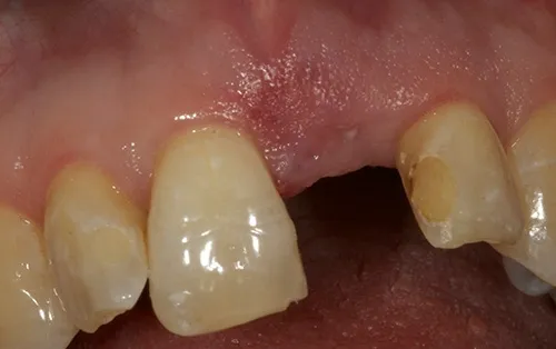 Healed post extraction site