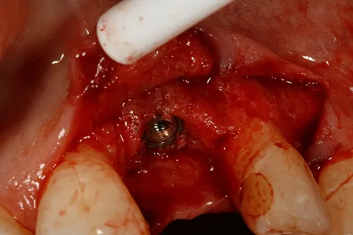 Implant placed in situ