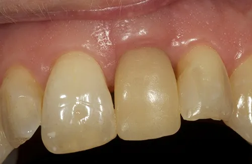Temp implant crown in situ