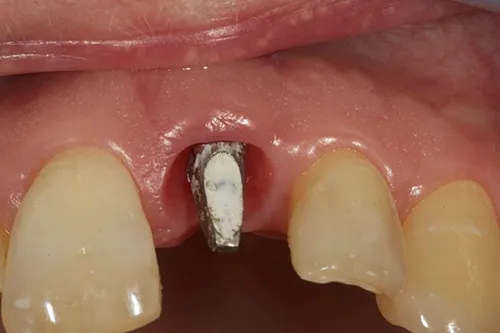 Implant abutment healed