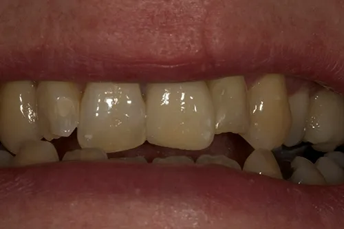 Post op smile