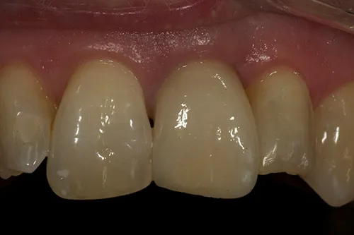 After treatment: Replacing a single tooth with an implant crown