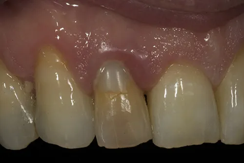 Before treatment: A single implant to replace a tooth with a fractured root
