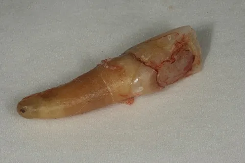 Fractured tooth root