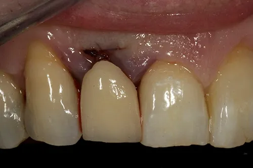 Temporary bridge post extraction