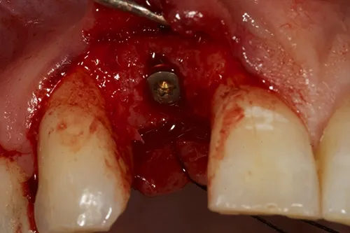 Implant fixture placed