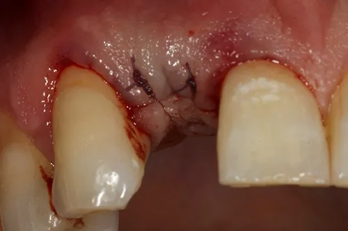 Implant surgery closed over