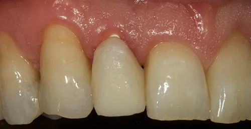 Implant temporary crown fitted