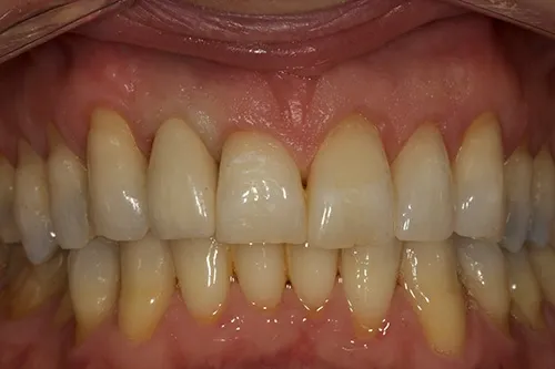 Post op smile