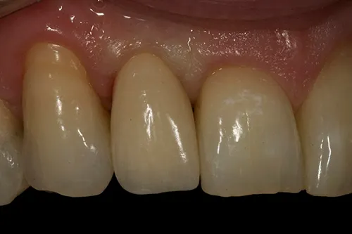 Post op close up of fitted implant crown