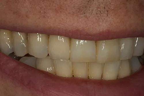 Smile post op after 2 weeks