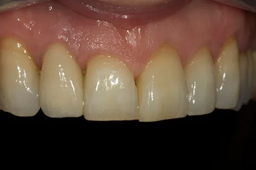 After treatment: A single implant to replace a tooth with a fractured root