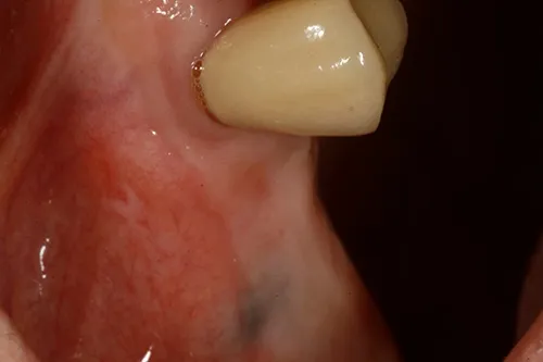 Before treatment: A single implant crown made from a digital scan