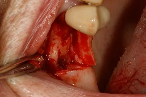 Exposed healthy ridge