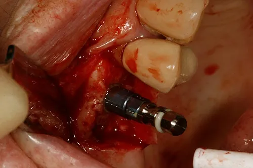 Implant placed in situ