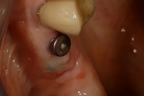 Implant healing abutment in situ