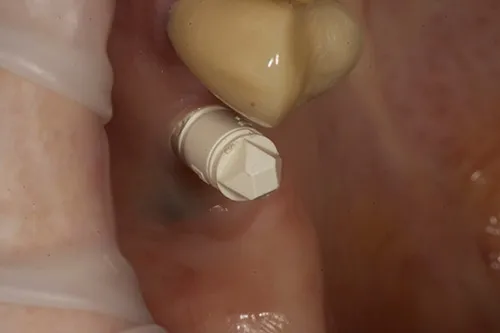 iTero implant scan body in situ