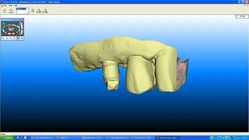 iTero digital scan taken of implant in situ