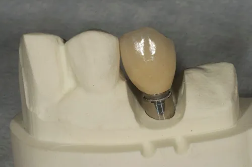 Implant crown made on iTero model