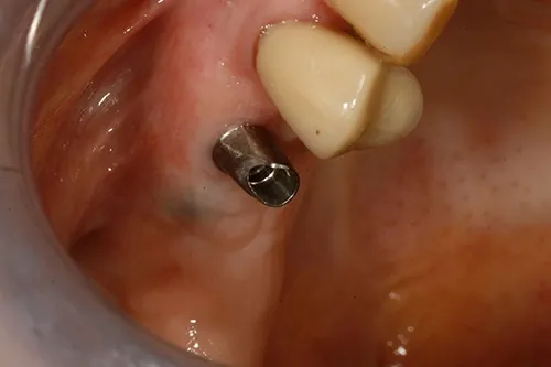 Implant abutment connected