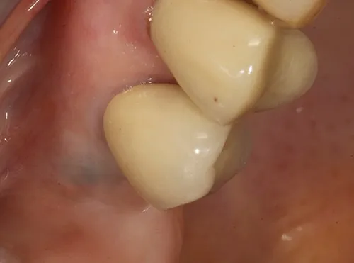 After treatment: A single implant crown made from a digital scan