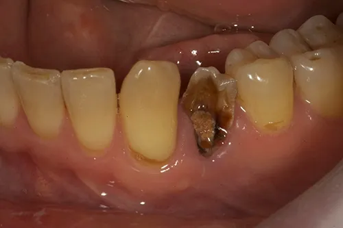 Before treatment: Replacing a broken tooth with a single implant