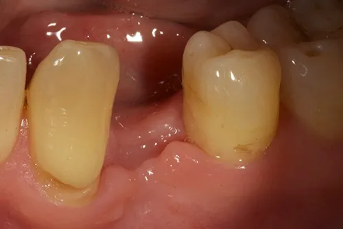 Healed extraction site