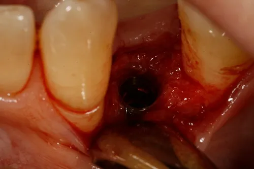 Implant fixture placed in situ