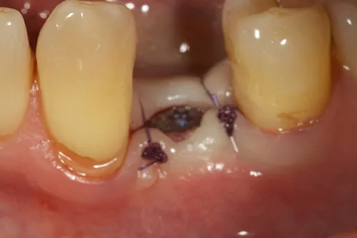 Implant surgical site closed
