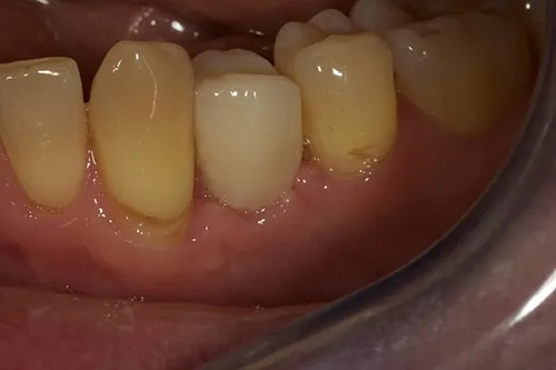 Implant temporary crown placed