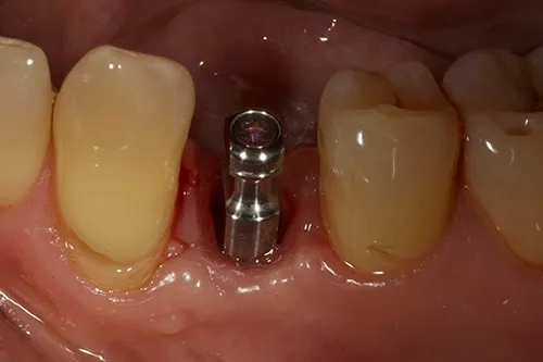 Implant impression post placed