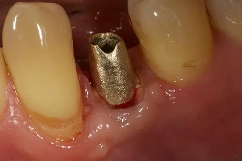 Customised gold abutment, made for an accurate fit and shape