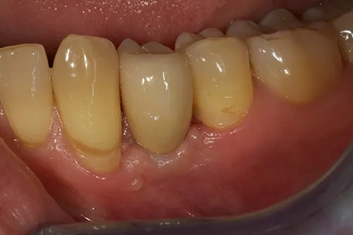 Implant crown fitted in situ