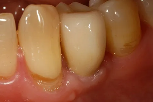 After treatment: Replacing a broken tooth with a single implant