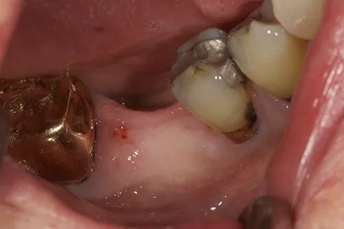 Before treatment: A single implant with guided bone regeneration