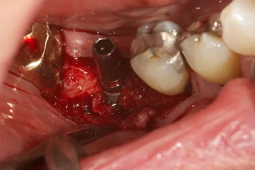 Implant fixture placed in situ
