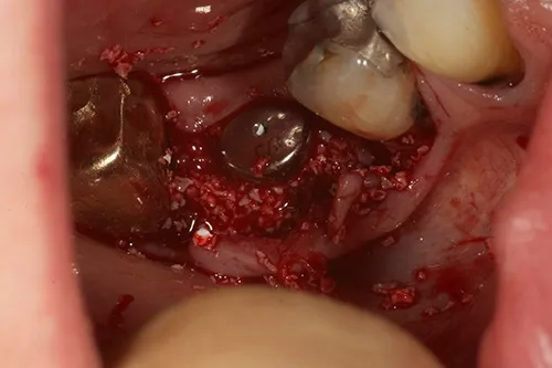 Implant fixture with guided bone regeneration