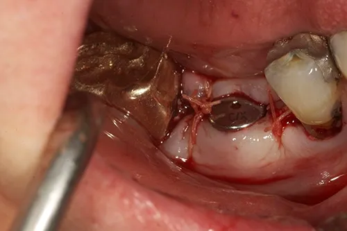 Implant site closed post surgery