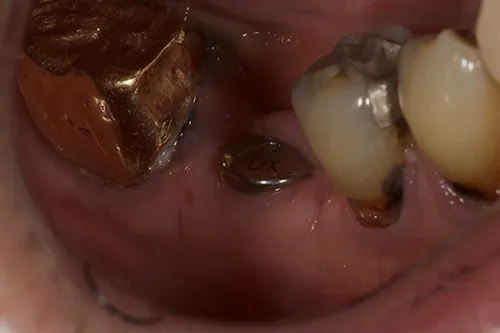 Healed implant healing abutment post placement