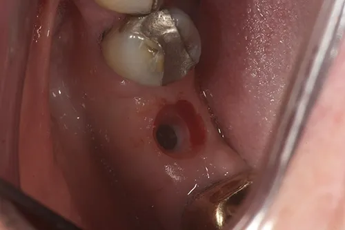 Emergence profile developed post surg