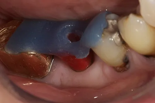 Acrylic jig used to seat permanent abutment