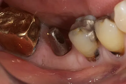Implant abutment in situ