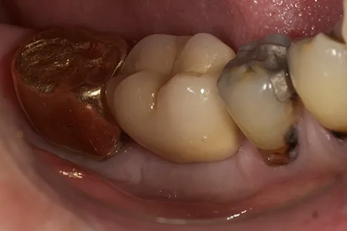 After treatment: A single implant with guided bone regeneration