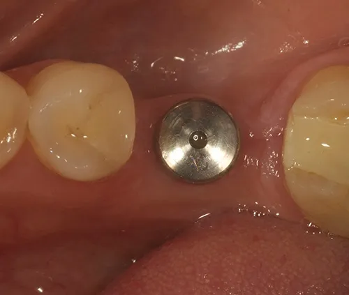 Before treatment: Fitting the crown on a single implant