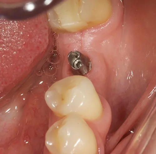 Implant abutment tried in situ